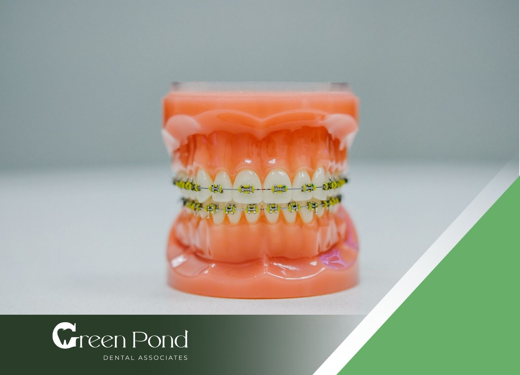 A Complete Guide To Overbite Correction Green Pond Dental